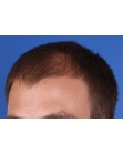 Before Hair Transplant&nbsp;Front
